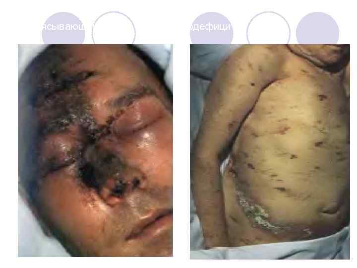 Опоясывающий лишай при иммунодефиците 