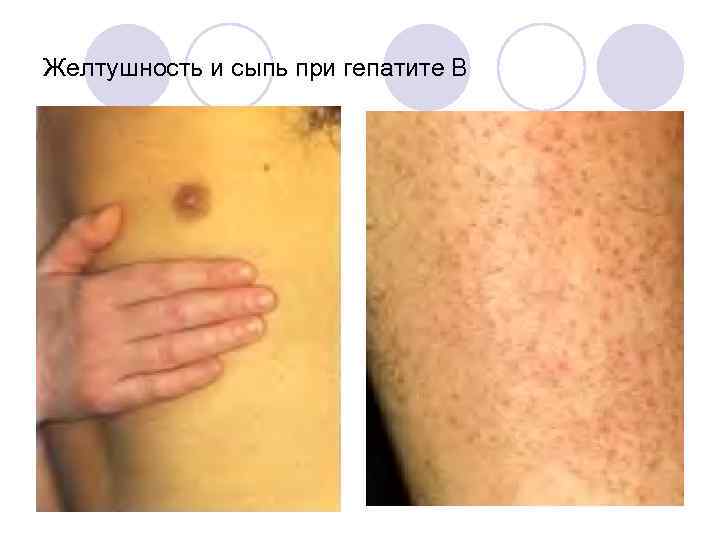 Желтушность и сыпь при гепатите В 
