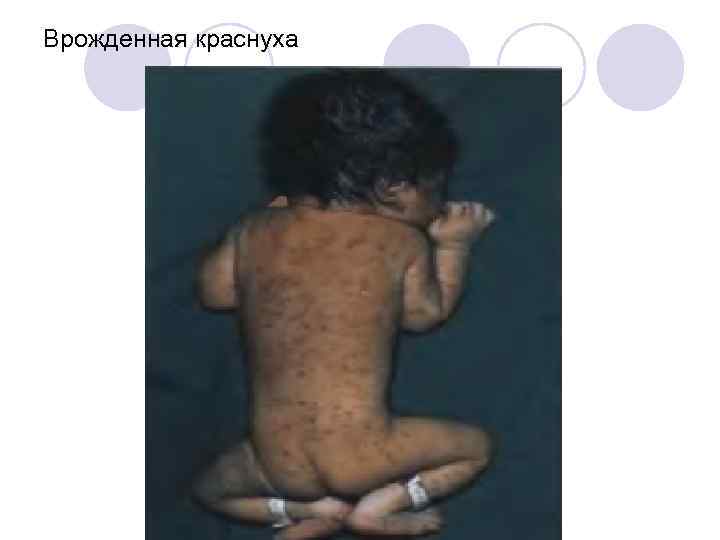 Врожденная краснуха 