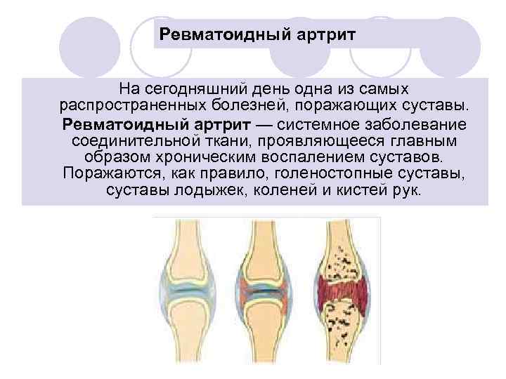 Ревматоидный артрит мышцы. Схема поражения суставов при ревматоидном артрите. Что поражается при ревматоидном артрите. Суставы при ревматоидном артрите. Характер поражения суставов при ревматоидном артрите.