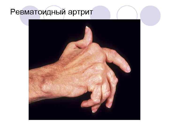 Ревматоидный артрит 