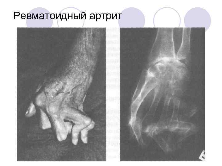 Ревматоидный артрит 