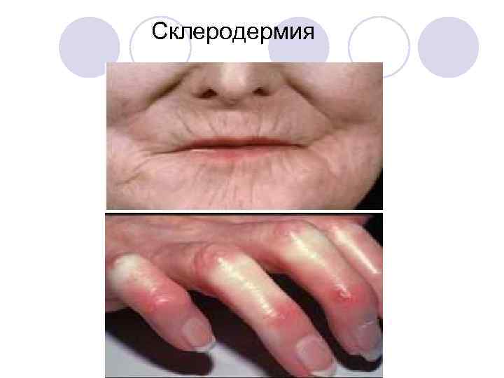  Склеродермия 