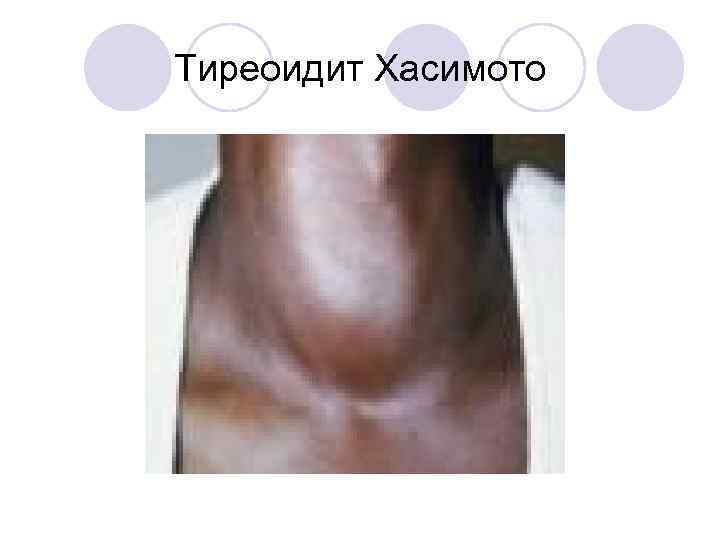 Тиреоидит Хасимото 