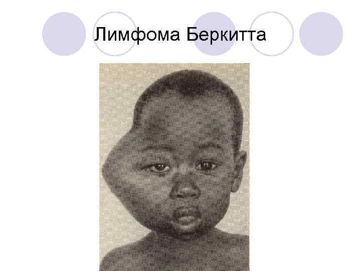 Лимфома Беркитта 