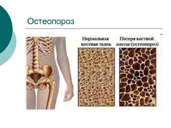 Остеопороз 