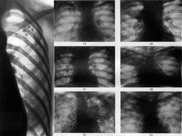 Туберкулез легких фото видео