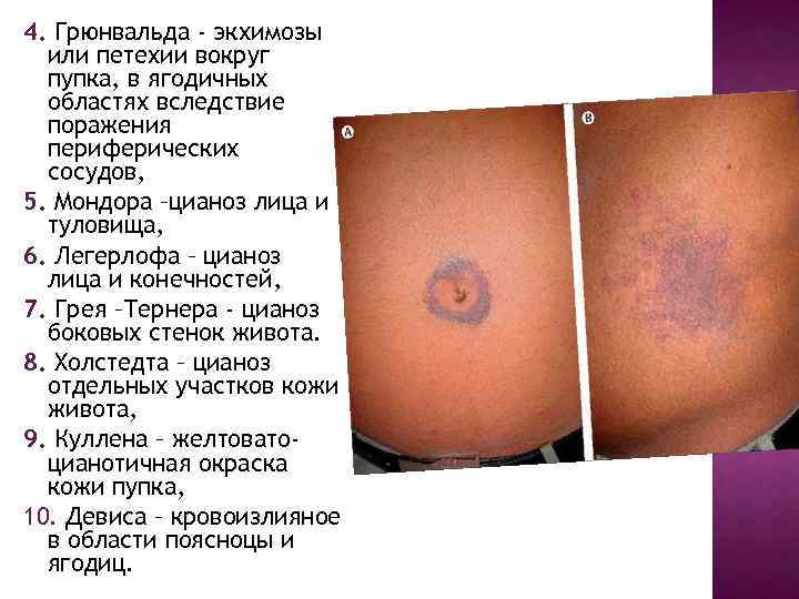 4. Грюнвальда - экхимозы или петехии вокруг пупка, в ягодичных областях вследствие поражения периферических