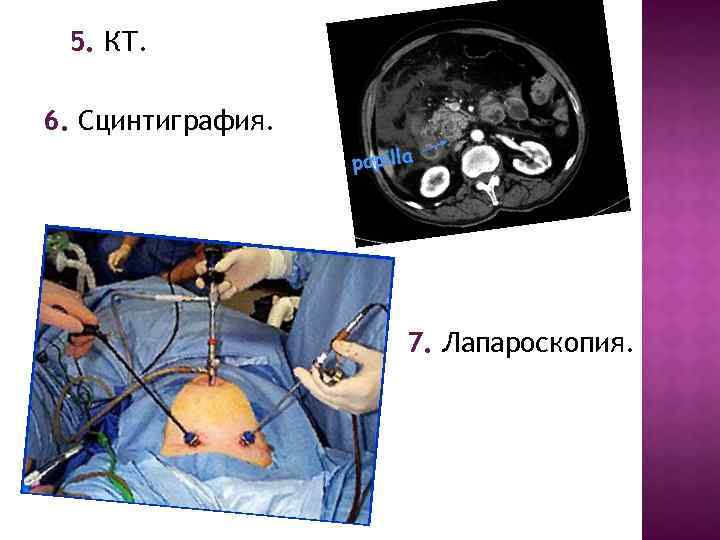 5. КТ. 6. Сцинтиграфия. 7. Лапароскопия. 