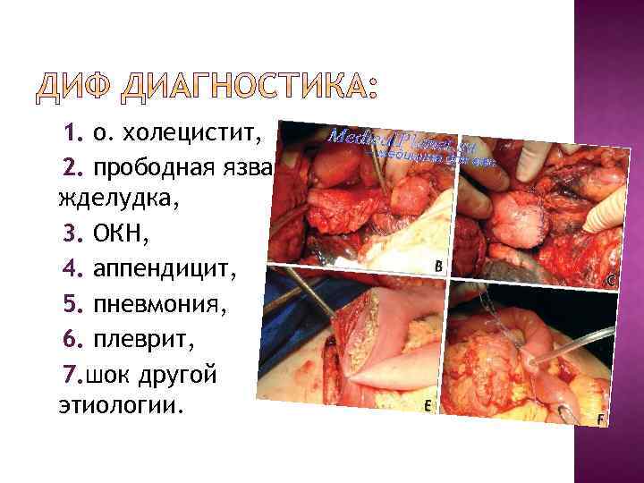 1. о. холецистит, 2. прободная язва жделудка, 3. ОКН, 4. аппендицит, 5. пневмония, 6.