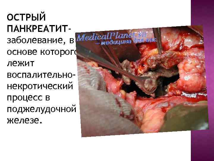 ОСТРЫЙ ПАНКРЕАТИТзаболевание, в основе которого лежит воспалительнонекротический процесс в поджелудочной железе. 