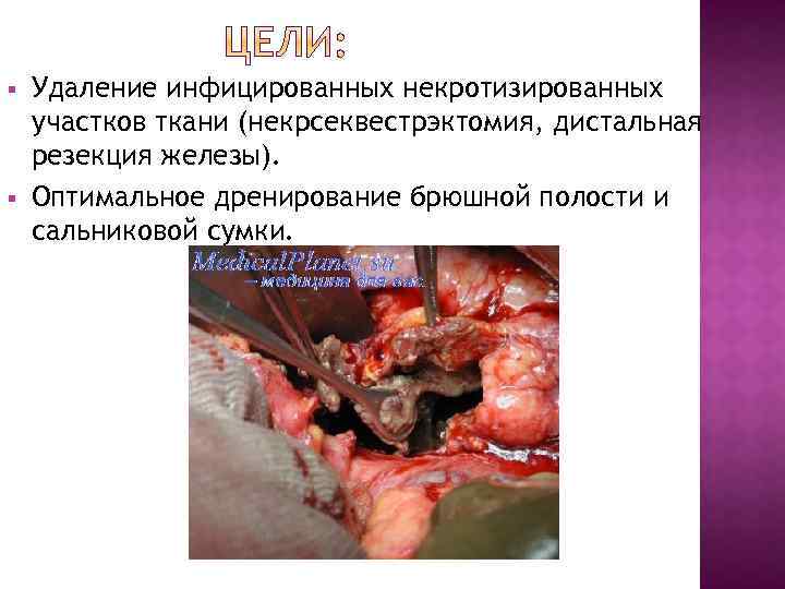 § § Удаление инфицированных некротизированных участков ткани (некрсеквестрэктомия, дистальная резекция железы). Оптимальное дренирование брюшной