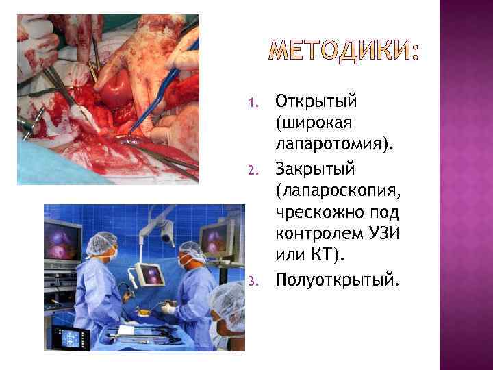 1. 2. 3. Открытый (широкая лапаротомия). Закрытый (лапароскопия, чрескожно под контролем УЗИ или КТ).