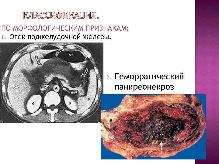 ПО МОРФОЛОГИЧЕСКИМ ПРИЗНАКАМ: 1. Отек поджелудочной железы. 2. Геморрагический панкреонекроз 