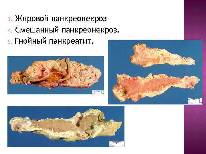 Жировой панкреонекроз 4. Смешанный панкреонекроз. 5. Гнойный панкреатит. 3. 