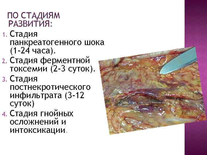 ПО СТАДИЯМ РАЗВИТИЯ: 1. Стадия панкреатогенного шока (1 -24 часа). 2. Стадия ферментной токсемии