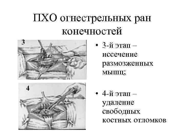 ПХО огнестрельных ран конечностей 3 • 3 -й этап – иссечение размозженных мышц; 4