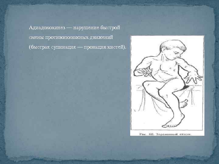 Адиадохокинез — нарушение быстрой смены противоположных движений (быстрая супинация — пронация кистей). 