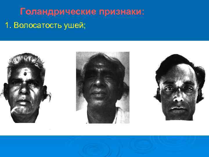 Голандрические признаки: 1. Волосатость ушей; 