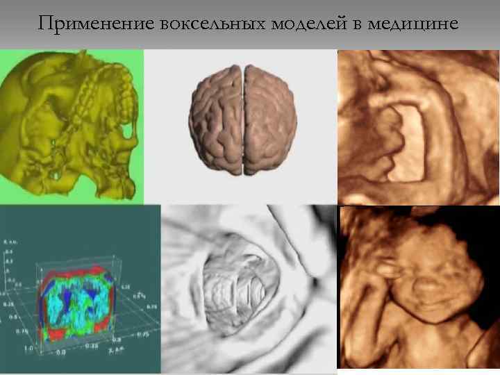 Применение воксельных моделей в медицине 