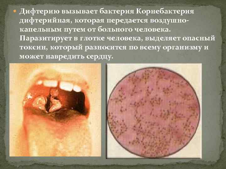  Дифтерию вызывает бактерия Корнебактерия дифтерийная, которая передается воздушнокапельным путем от больного человека. Паразитирует