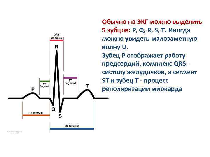 Обычно на ЭКГ можно выделить 5 зубцов: P, Q, R, S, T. Иногда можно