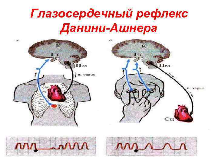 Схема глазосердечного рефлекса