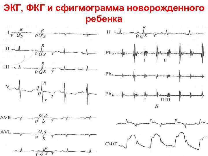 ЭКГ, ФКГ и сфигмограмма новорожденного ребенка 