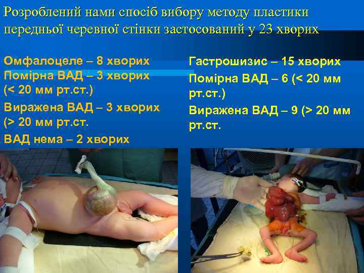 Розроблений нами спосіб вибору методу пластики передньої черевної стінки застосований у 23 хворих Омфалоцеле