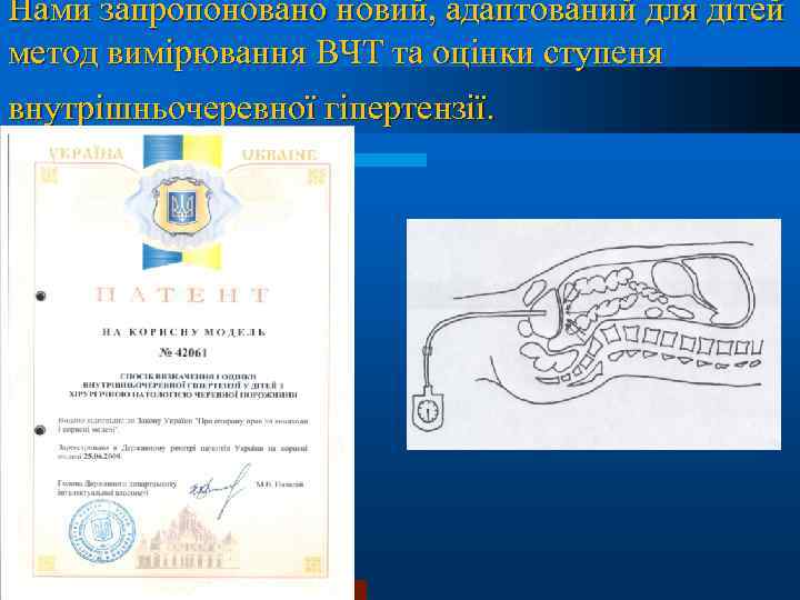 Нами запропоновано новий, адаптований для дітей метод вимірювання ВЧТ та оцінки ступеня внутрішньочеревної гіпертензії.