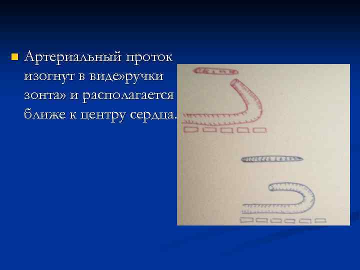 n Артериальный проток изогнут в виде» ручки зонта» и располагается ближе к центру сердца.
