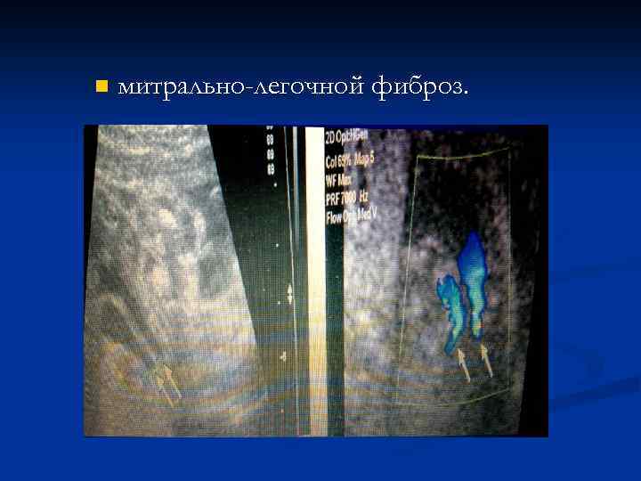 n митрально-легочной фиброз. 