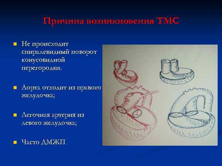 Причина возникновения ТМС n Не происходит спиралевидный поворот конусовидной перегородки. n Аорта отходит из