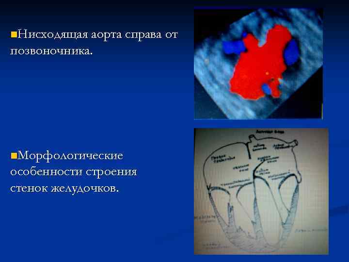 Транспозиция магистральных артерий презентация