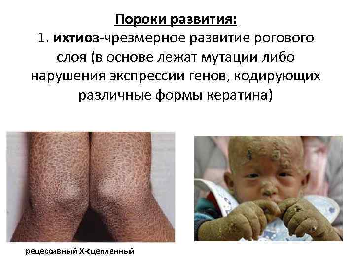 Пороки развития: 1. ихтиоз-чрезмерное развитие рогового слоя (в основе лежат мутации либо нарушения экспрессии