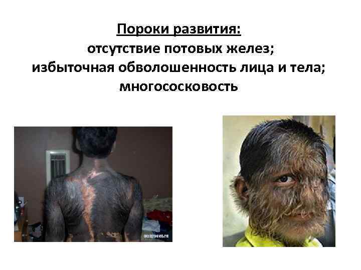 Пороки развития: отсутствие потовых желез; избыточная обволошенность лица и тела; многососковость 