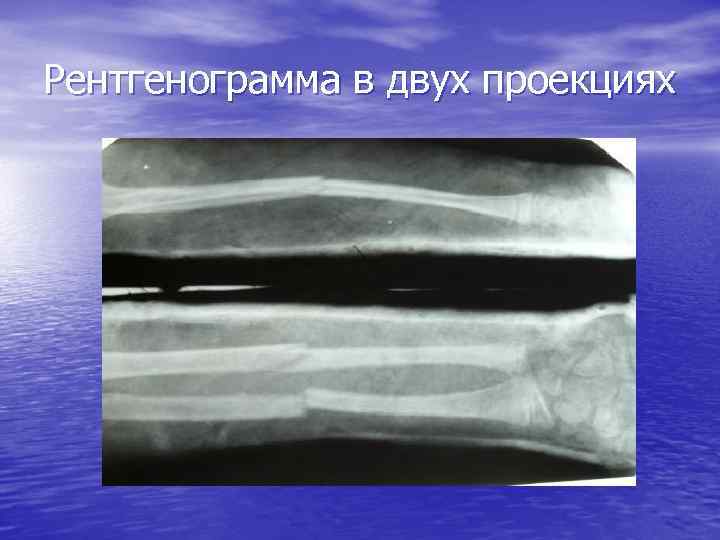 Рентгенограмма в двух проекциях 