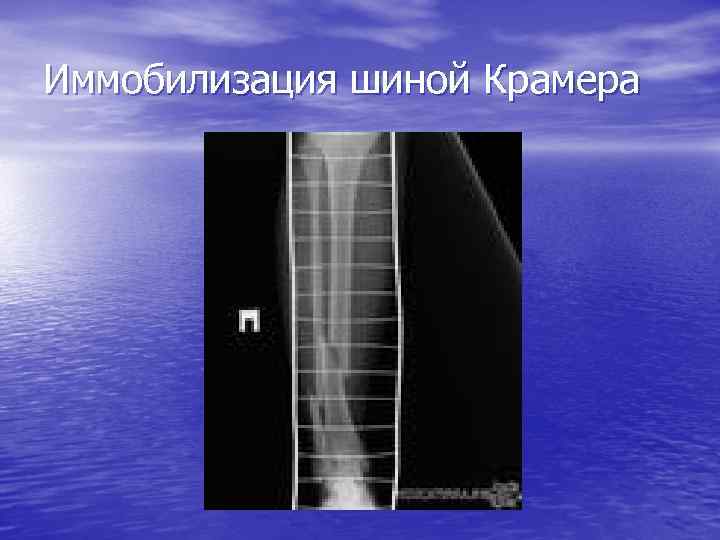 Иммобилизация шиной Крамера 
