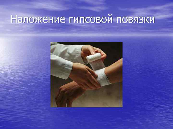 Наложение гипсовой повязки 