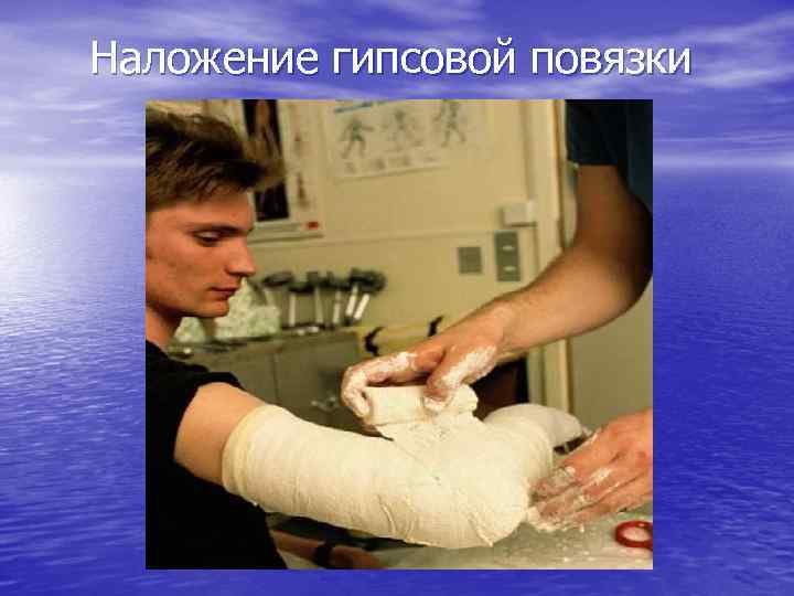 Наложение гипсовой повязки 