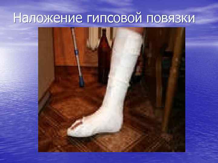 Наложение гипсовой повязки 