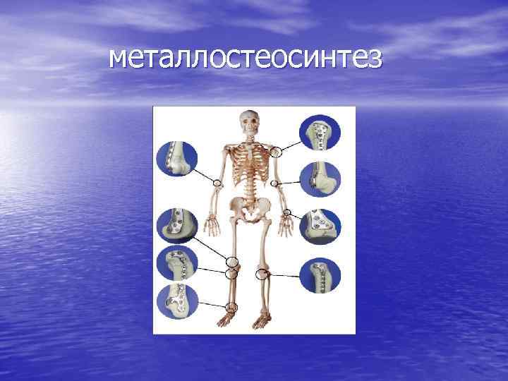 металлостеосинтез 