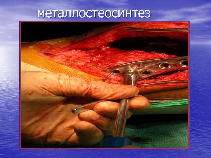 металлостеосинтез 