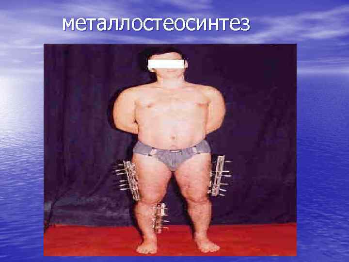 металлостеосинтез 
