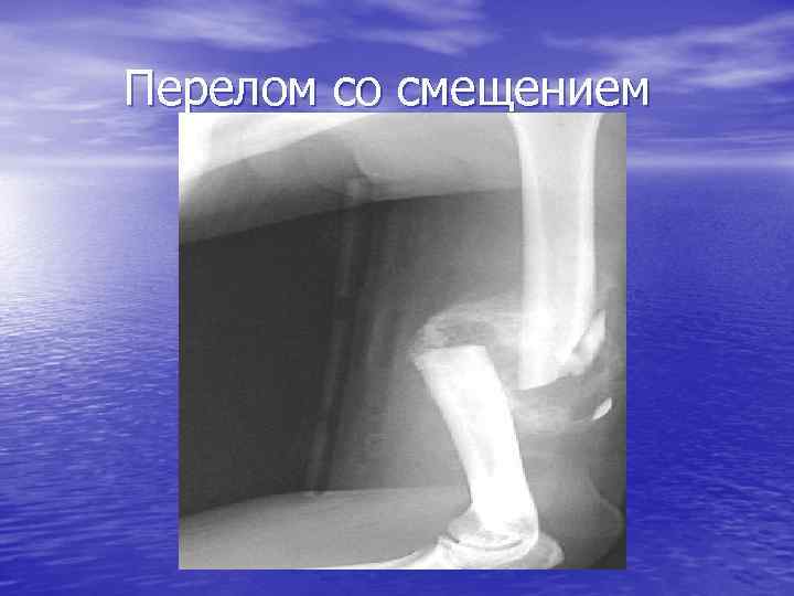 Перелом со смещением 