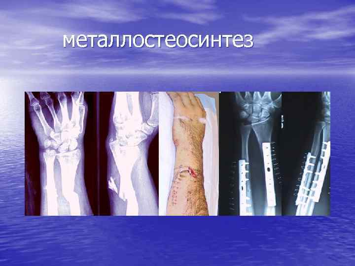 металлостеосинтез 