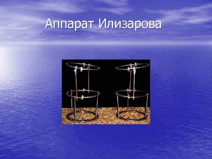 Аппарат Илизарова 