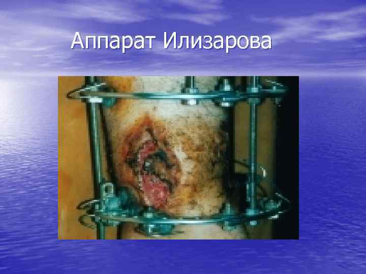 Аппарат Илизарова 
