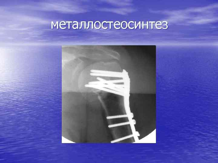 металлостеосинтез 