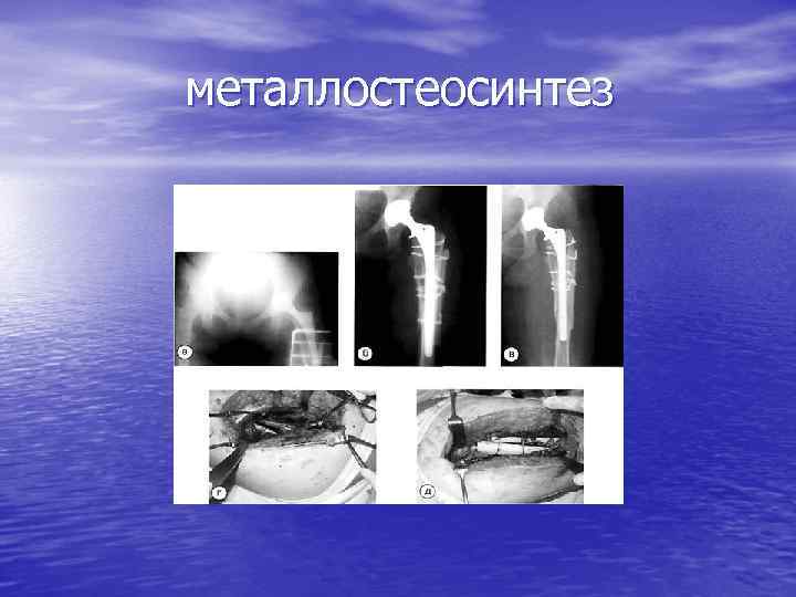металлостеосинтез 